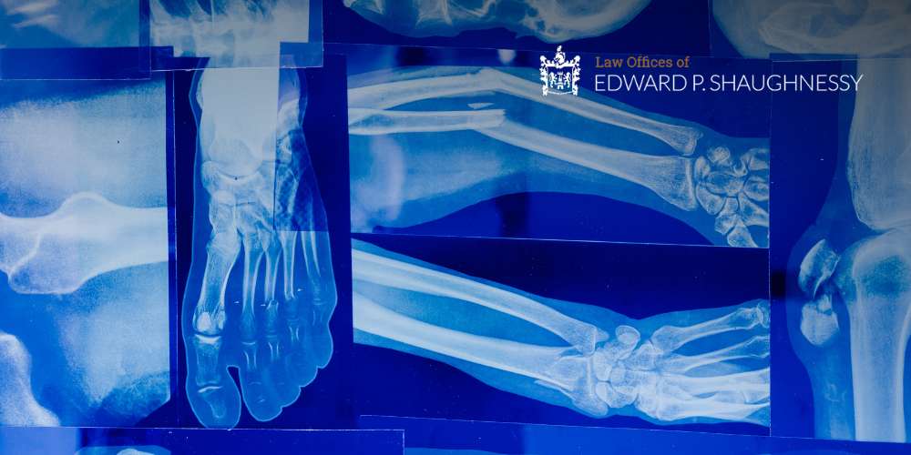 Lehigh Valley broken bone attorney