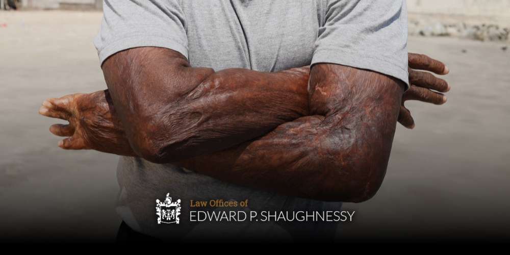 Easton Disfigurement injury lawyer