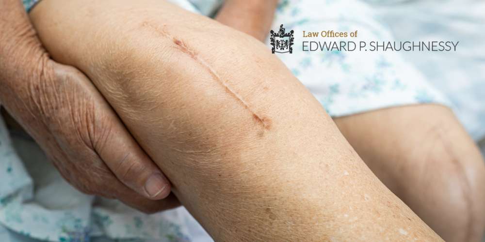 Easton Scar and Disfigurement Lawyer