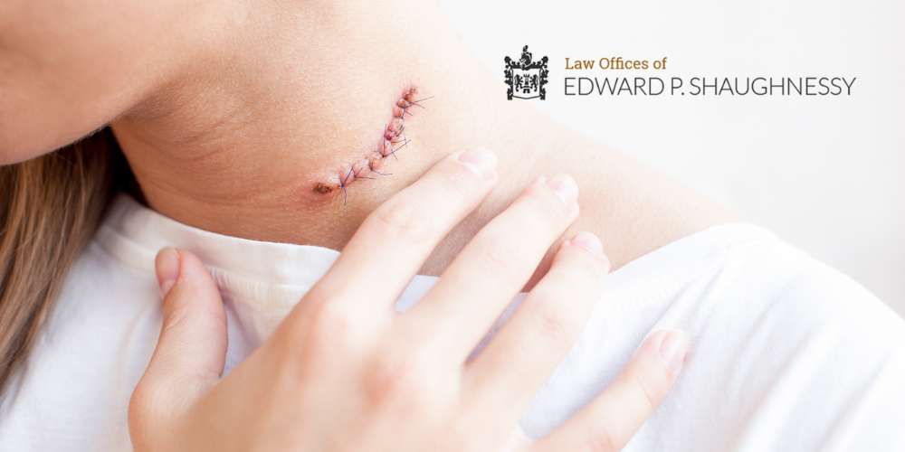 Easton disfigurement lawyer