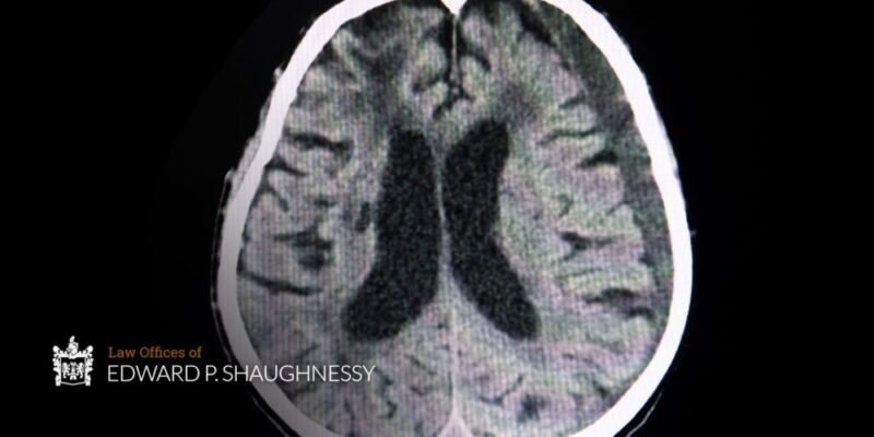 What Is A Subdural Hematoma